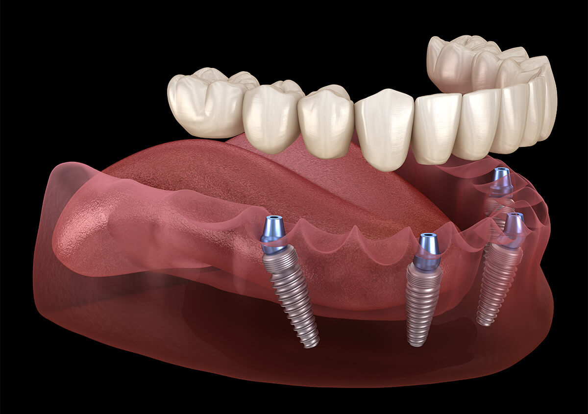 Lower Implant Retained Dentures in Calgary AB Area